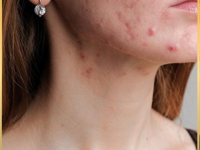 Cómo tratar el acné