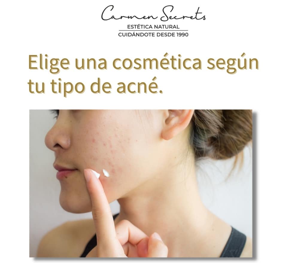 elige una cosmética según tu tipo de acné