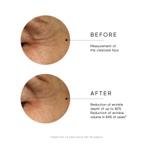 Párpado de persona antes y después de ringana