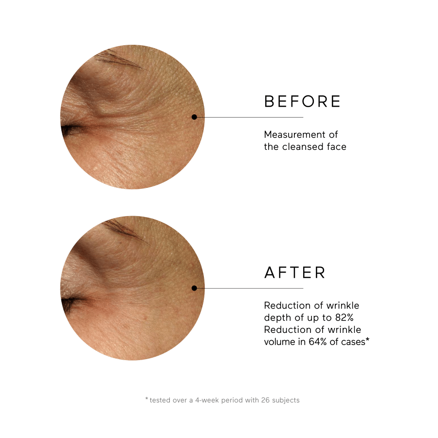 Párpado de persona antes y después de ringana