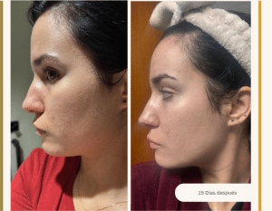 Antes y después del tratamiento del acné hormonal en Carmen Secrets