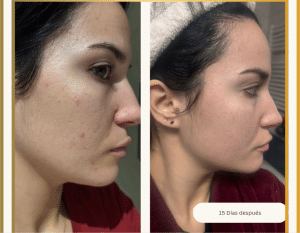 Antes y después del tratamiento del acné hormonal en Carmen Secrets