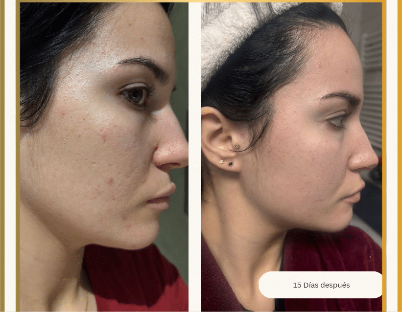 Antes y después del tratamiento del acné hormonal en Carmen Secrets