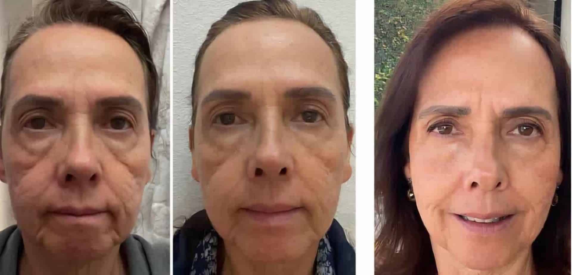 Caso real antes y después de tratamientos para rejuvenecer la cara sin cirugía con mejora visible en firmeza y textura de la piel