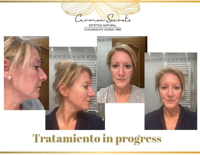 Caso real de tratamientos para rejuvenecer la cara sin cirugía mostrando evolución de la piel durante el proceso