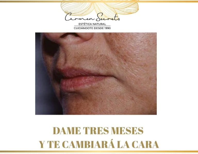 Tratamientos para rejuvenecer la cara sin cirugía — mejora visible de la textura y firmeza de la piel